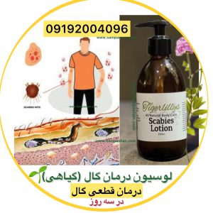 درمان گال سریع قطعی تضمینی
