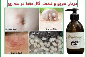 درمان گال با واجبی