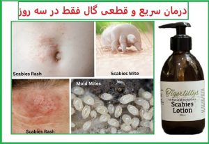 درمان گال با واجبی