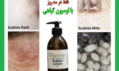 درمان سریع گال در خانه