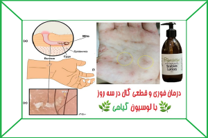 درمان گال با زردچوبه
