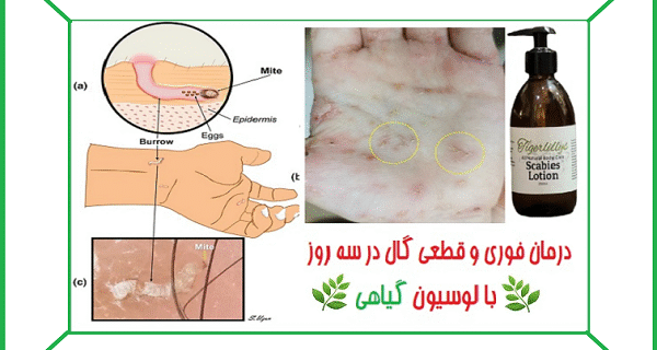 درمان گال با زردچوبه