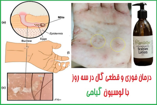 درمان گال با زرد چوبه