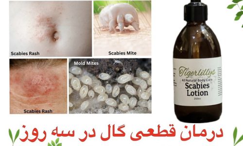 درمان گال نروژی