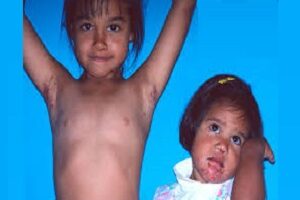 درمان گال کودکان