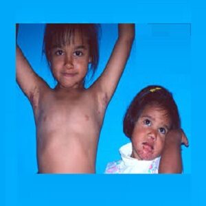 درمان گال کودکان