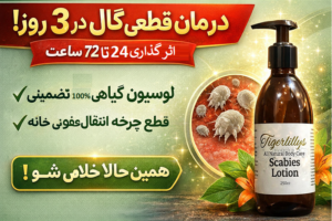 درمان قطعی گال در ۳ روز